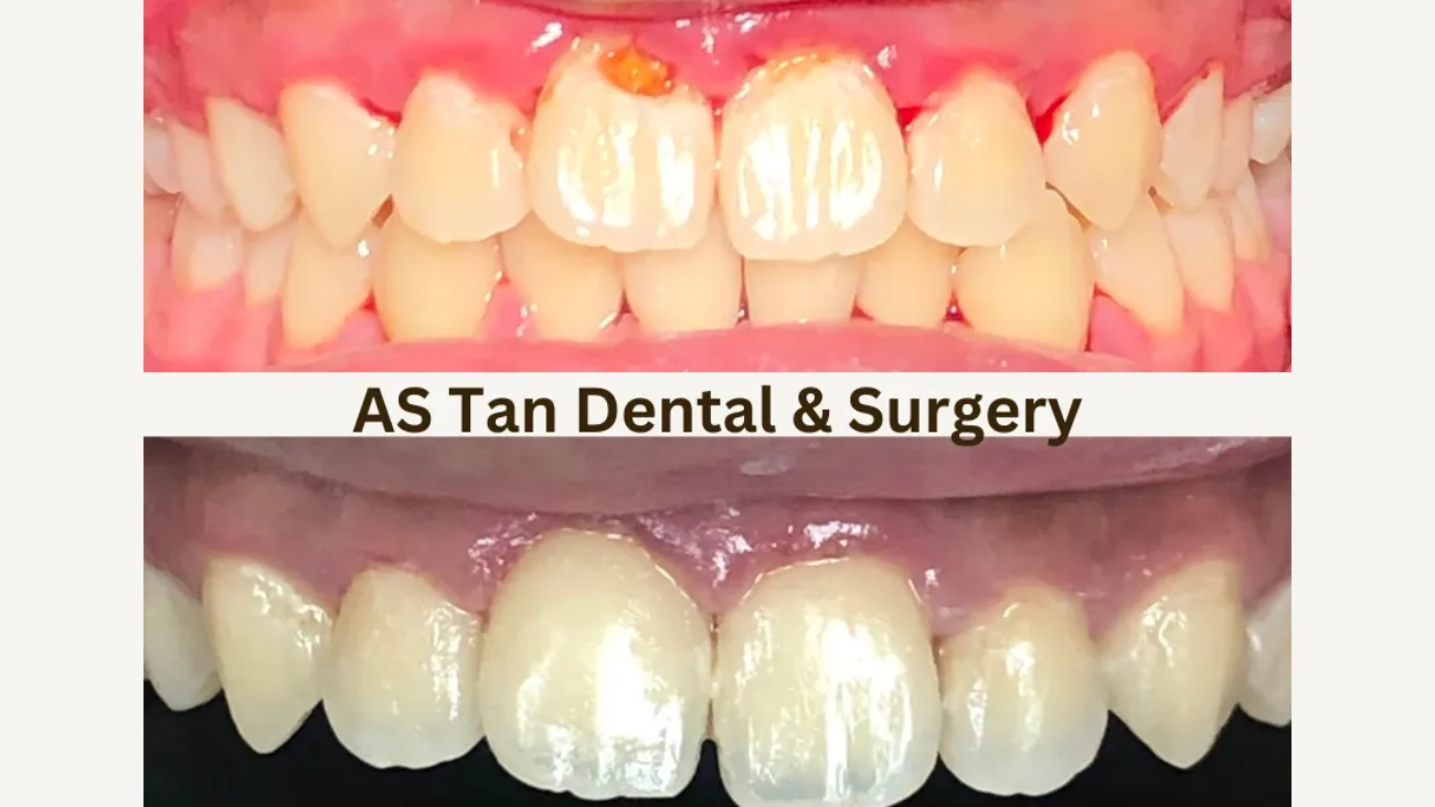 Aesthetic Fillings